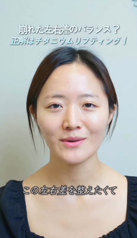 @idclinicjp · チタニウムリフト、チタンリフト、リフティング