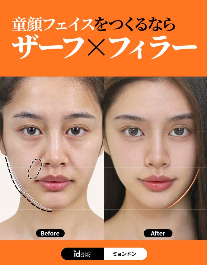 @idclinicjp · ザーフ、フィラー、ヒアルロン酸