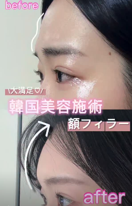 @idclinicjp · ヒアルロン酸